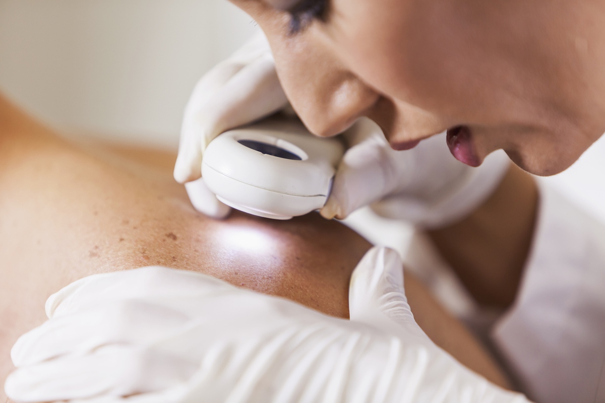 Melasma: saiba diferenciar os 3 tipos da doença e a melhor forma de tratar